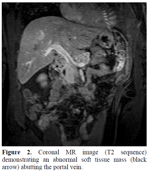 pancreas-coronal-mr-image-abnormal-soft