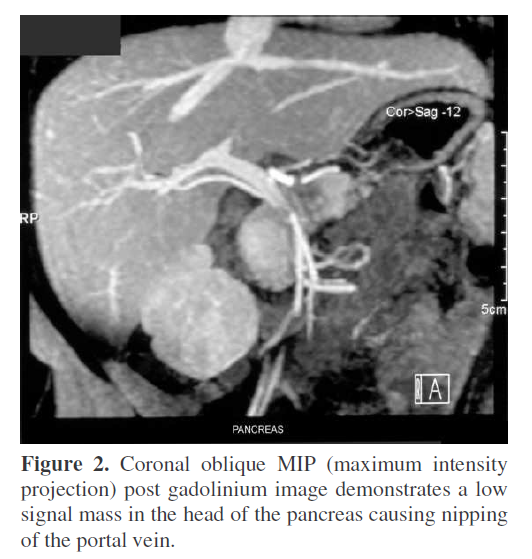 pancreas-coronal-oblique-MIP