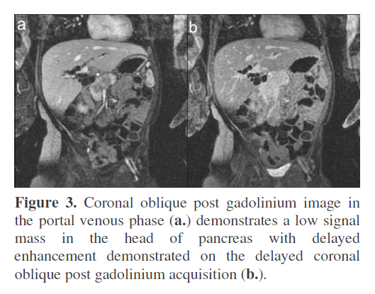 pancreas-coronal-oblique-post-gadolinium