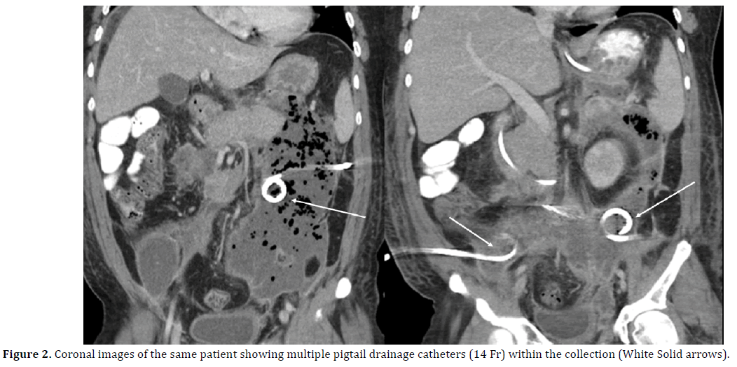 pancreas-coronal-patient-pigtail