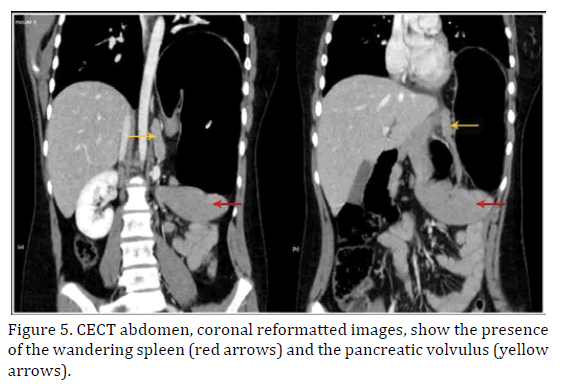 pancreas-coronal-reformatted