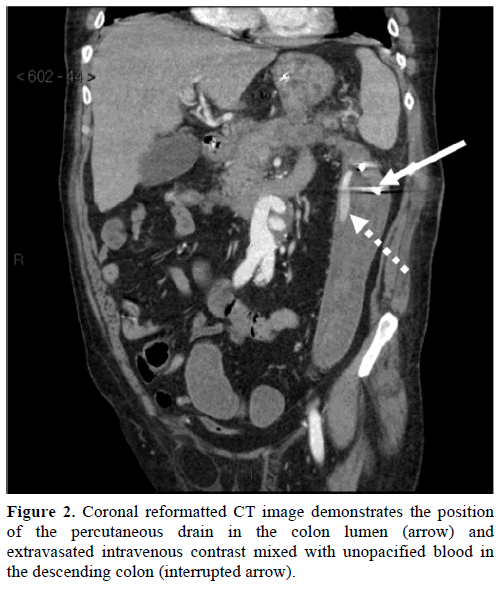 pancreas-coronal-reformatted-position