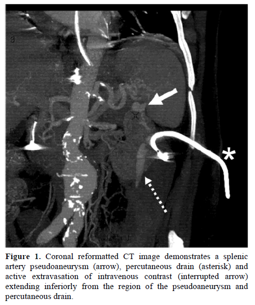 pancreas-coronal-reformatted-splenic