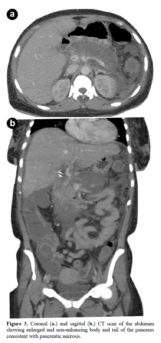 pancreas-coronal-sagittal-abdomen
