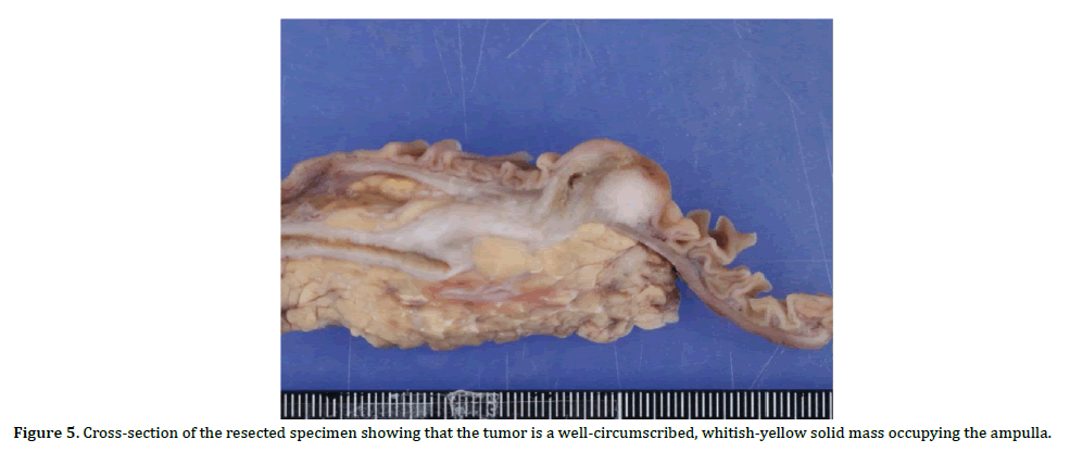 pancreas-cross-section-specimen-tumor