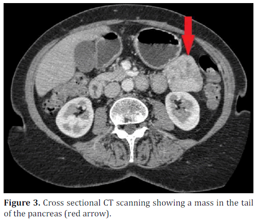 pancreas-cross-sectional-mass-tail