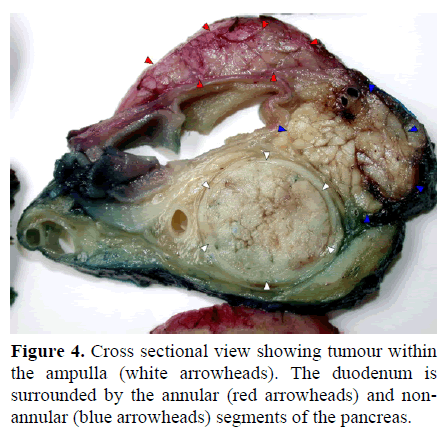 pancreas-cross-sectional-view-tumour