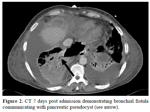 pancreas-ct-7-days-admission-bronchial