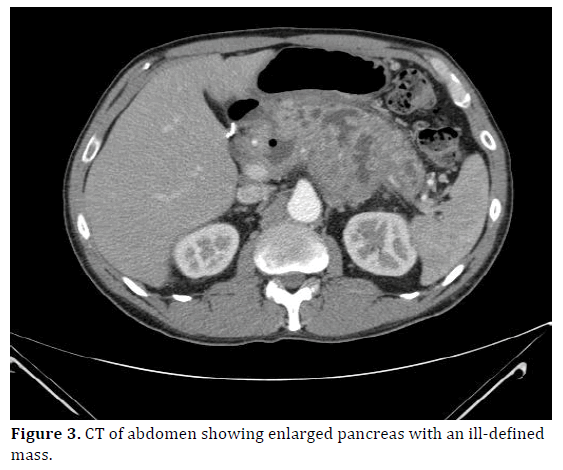 pancreas-ct-abdomen-enlarged-pancreas