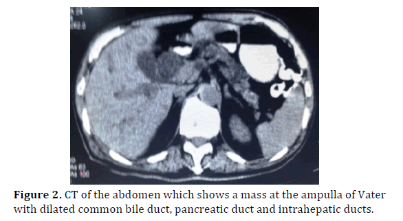 pancreas-ct-abdomen-mass-ampulla