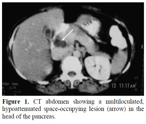 pancreas-ct-abdomen-multiloculated