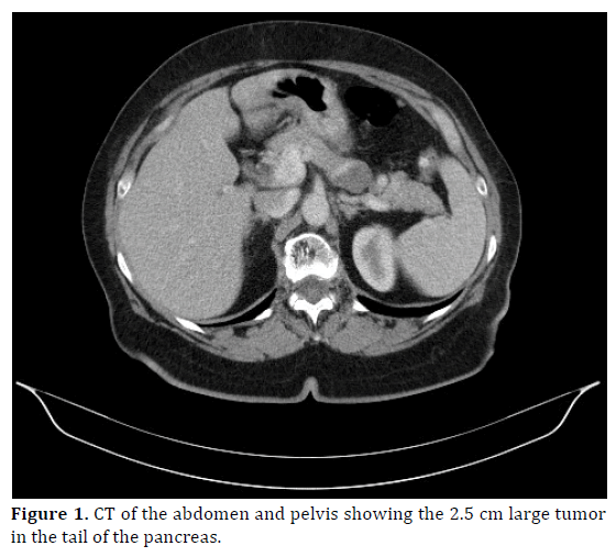 pancreas-ct-abdomen-pelvis-large-tumor