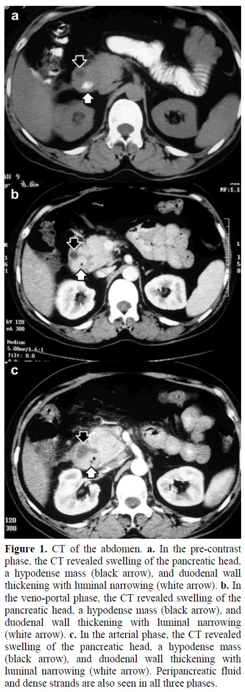 pancreas-ct-abdomen-pre-contrast