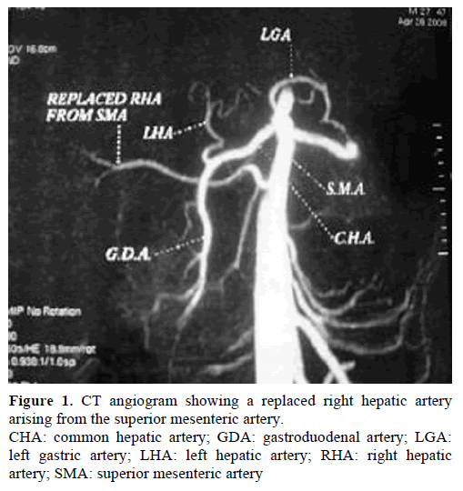 pancreas-ct-angiogram-right-hepatic