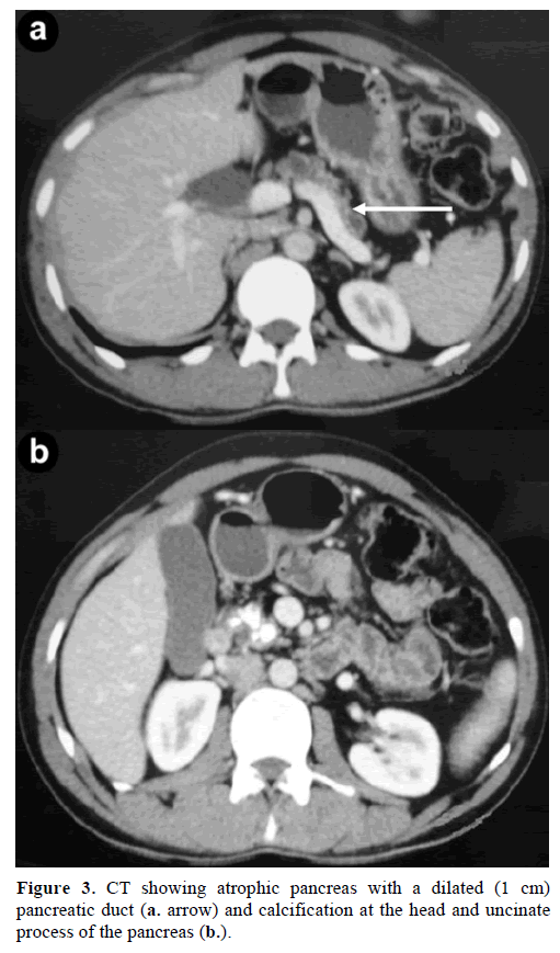 pancreas-ct-atrophic-pancreas-uncinate