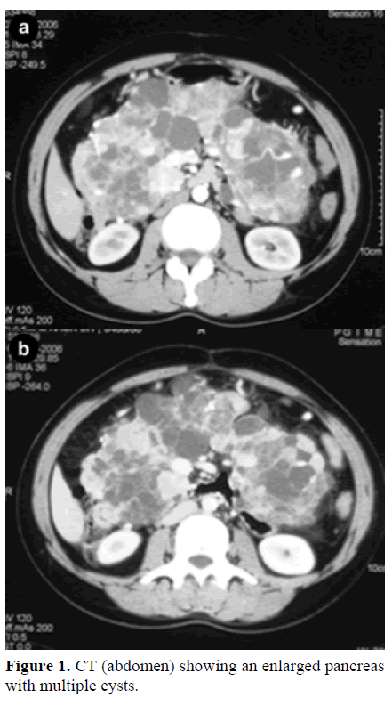 pancreas-ct-enlarged-pancreas-cysts