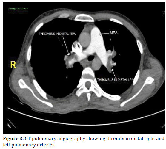 pancreas-ct-pulmonary-angiography-distal