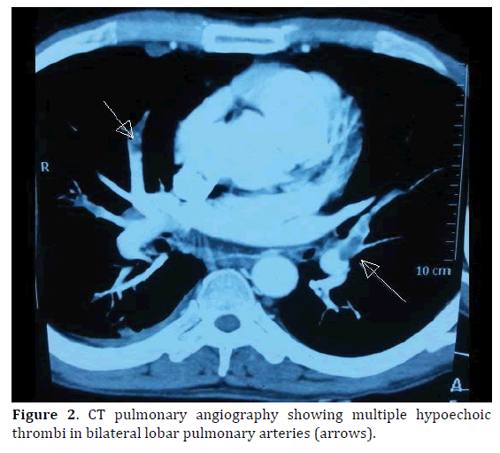 pancreas-ct-pulmonary-angiography-lobar