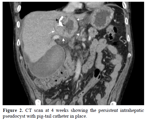pancreas-ct-scan-4-weeks-intrahepatic