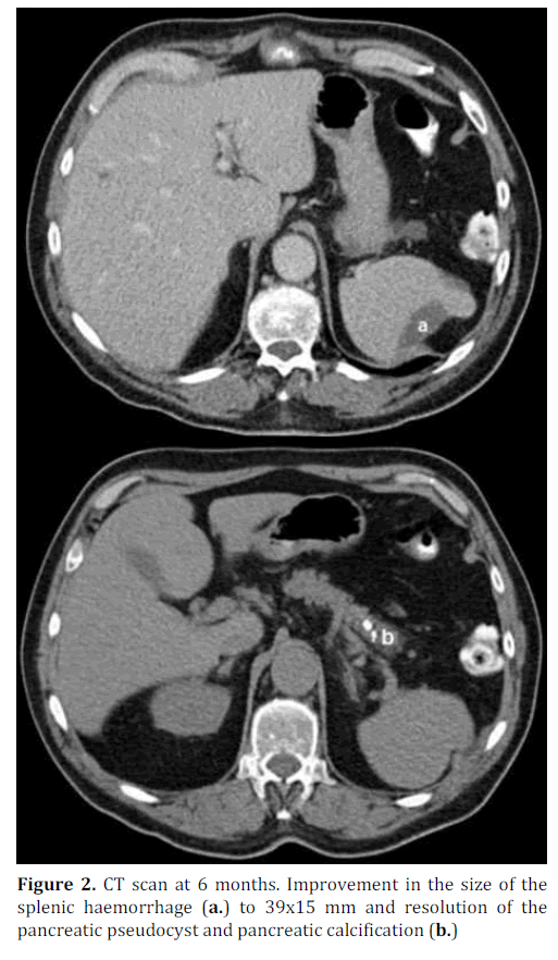 pancreas-ct-scan-6-months