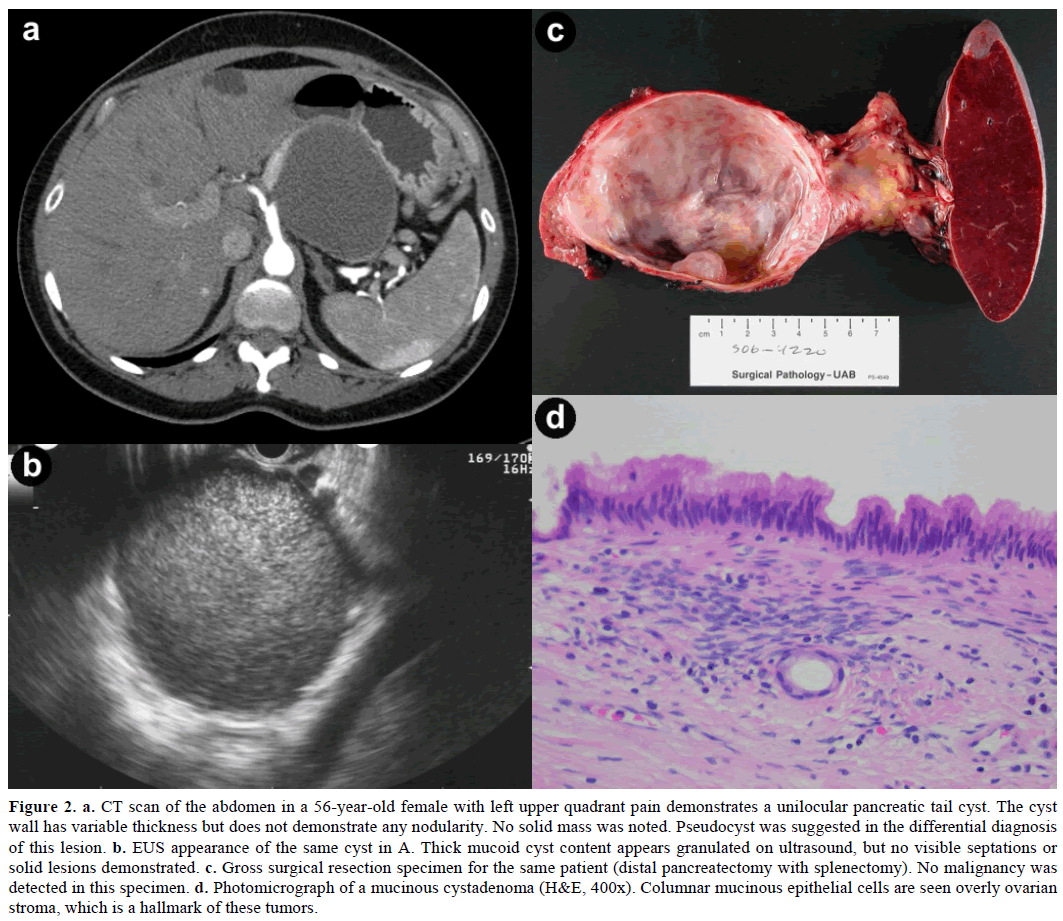 pancreas-ct-scan-abdomen-56-year-old