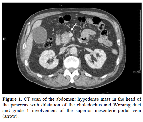 pancreas-ct-scan-abdomen-hypodense