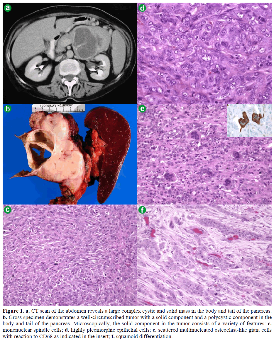 pancreas-ct-scan-abdomen-reveals