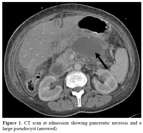 pancreas-ct-scan-admission-necrosis