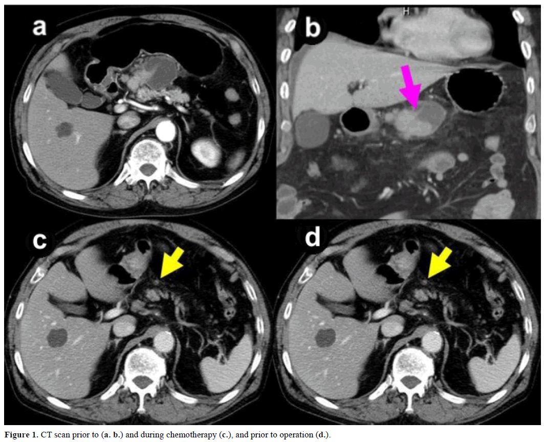 pancreas-ct-scan-chemotherapy-operation