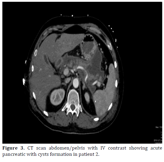 pancreas-ct-scan-cysts-formation