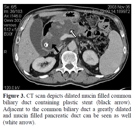 pancreas-ct-scan-depicts-mucin