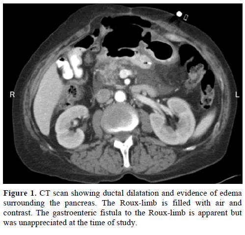 pancreas-ct-scan-ductal-dilatation