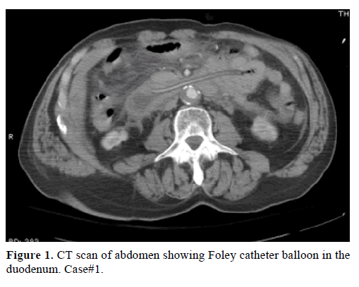 pancreas-ct-scan-foley-catheter-balloon