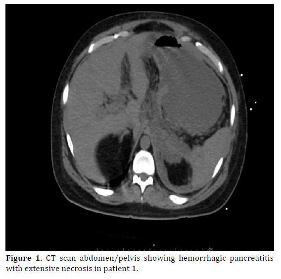 pancreas-ct-scan-hemorrhagic-pancreatitis