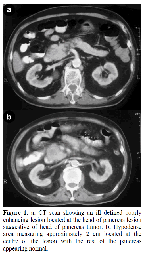 pancreas-ct-scan-ill-defined-poorly