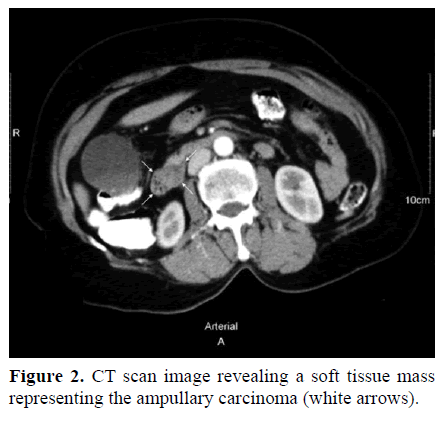 pancreas-ct-scan-image-ampullary
