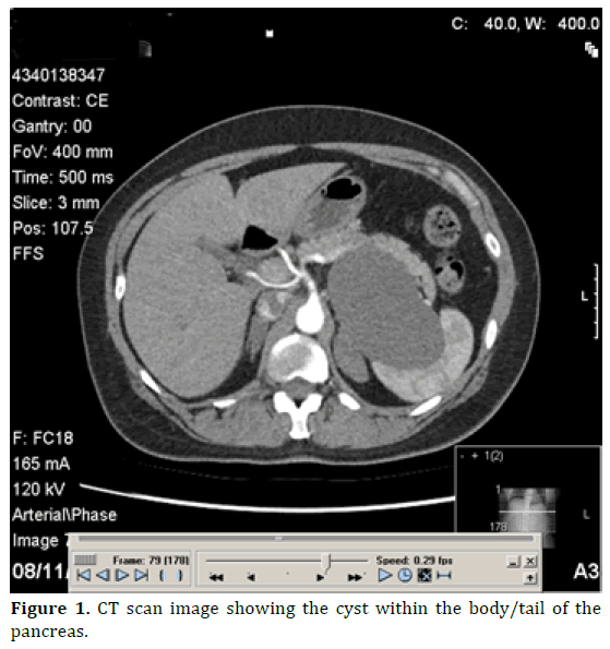 pancreas-ct-scan-image-cyst-body-tail
