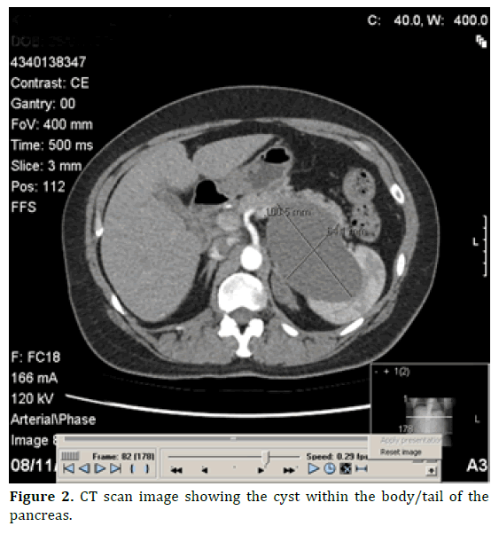 pancreas-ct-scan-image-cyst-body-tail