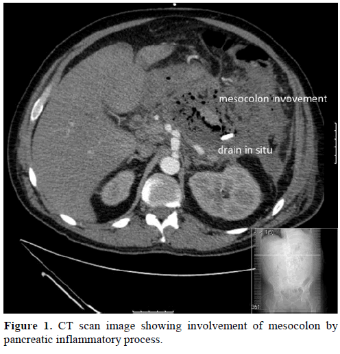 pancreas-ct-scan-image-mesocolon