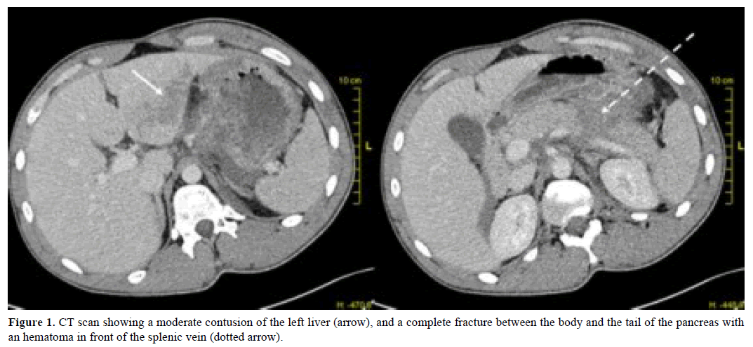 pancreas-ct-scan-moderate-contusion