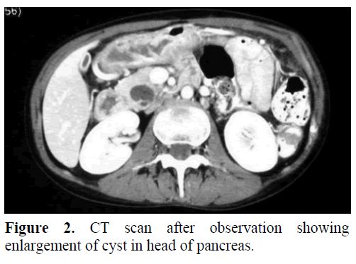pancreas-ct-scan-observation-enlargement