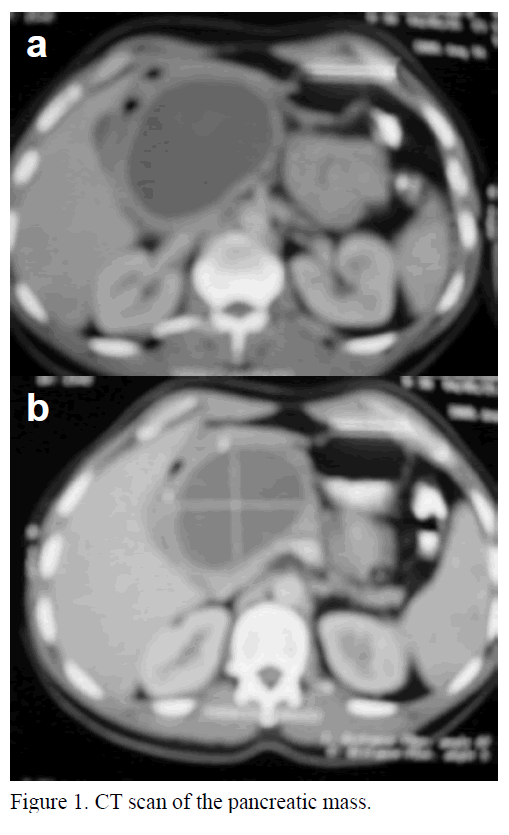 pancreas-ct-scan-pancreatic-mass