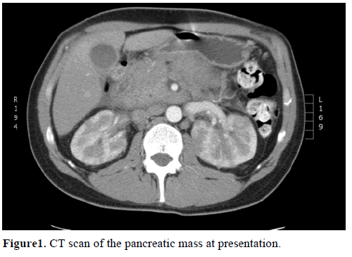 pancreas-ct-scan-pancreatic-mass-presentation