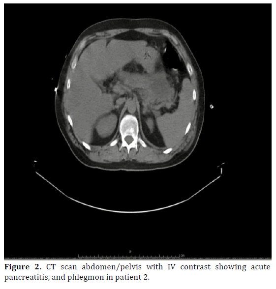 pancreas-ct-scan-pancreatitis-phlegmon