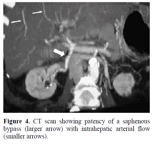 pancreas-ct-scan-patency-saphenous