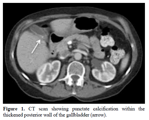 pancreas-ct-scan-punctate-calcification