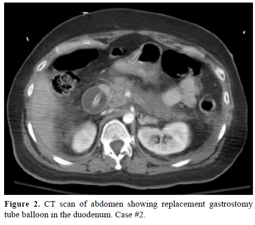 pancreas-ct-scan-replacement-gastrostomy