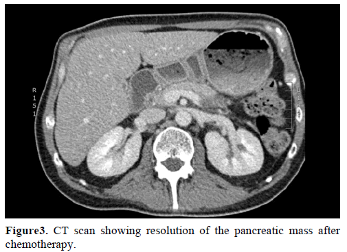 Obstructive Jaundice Due To A Pancreatic Mass A Rare Presentatio