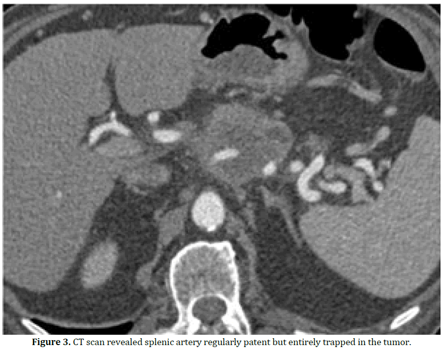 pancreas-ct-scan-revealed-splenic-artery