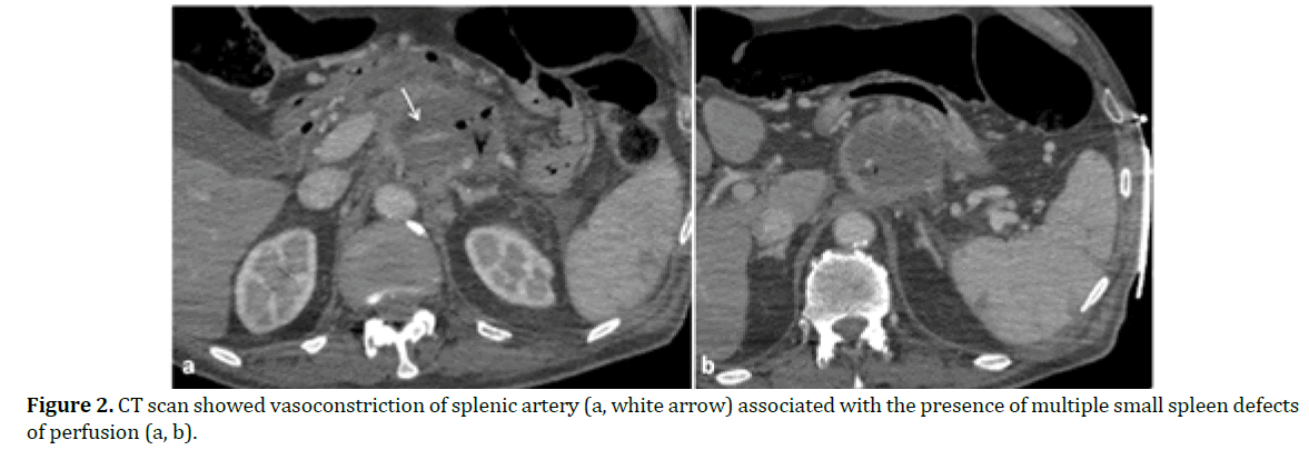 pancreas-ct-scan-showed-vasoconstriction